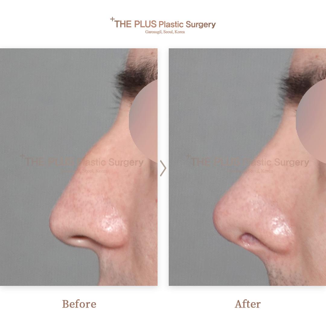 Primary Rhinoplasty & Hump Correction & Nose Osteotomy & Septal Cartilage & Tip Correction & Rhinitis