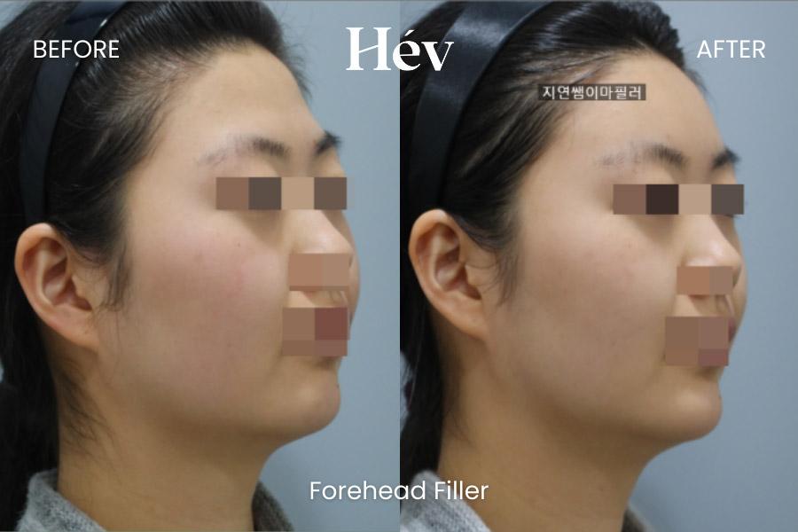 Forehead Filler