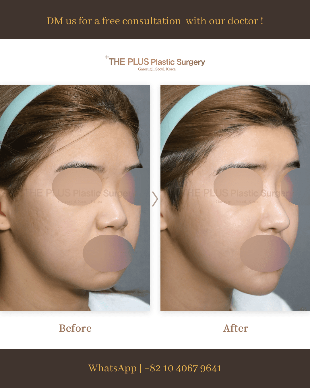 Chin Implant, Face Contouring, Face Fat Grafting