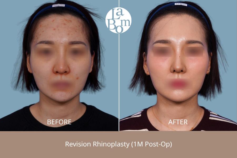 Before and After Revision Rhinoplasty