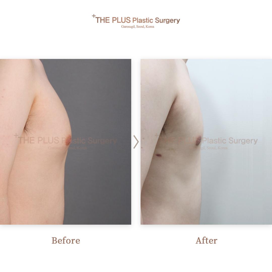 THEPLUS Plastic Surgery before and after image