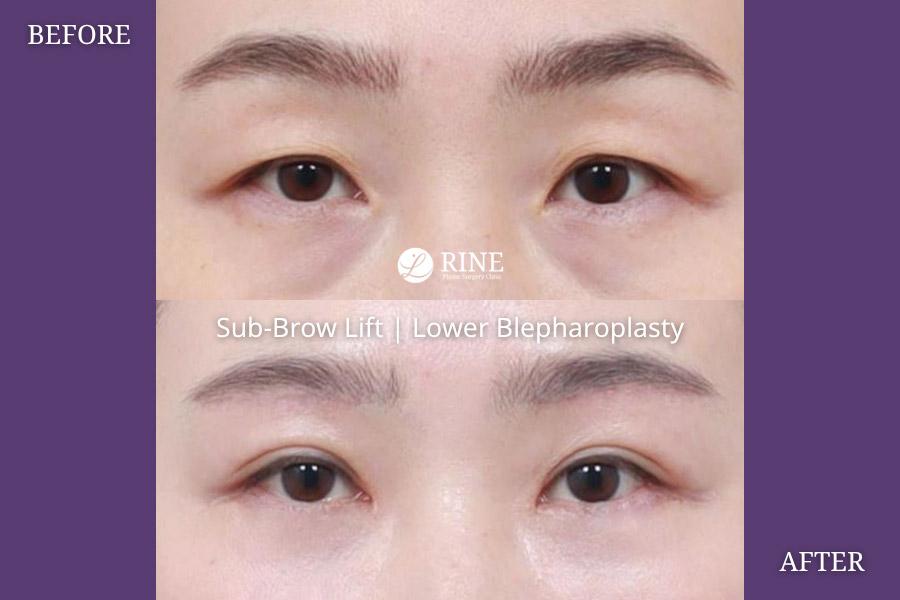Sub Brow lift lower blepharoplasty