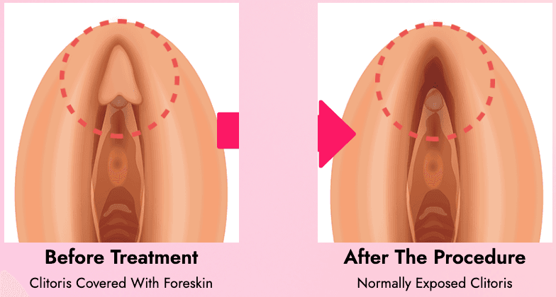 Clitoroplasty, Revision Clitoroplasty, Clitoral Hood Reduction, Clitoroplasty with Laser