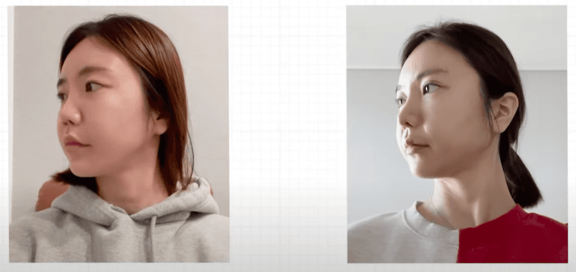 My Eye Revision Surgery Journey at Made Young Clinic in Korea
