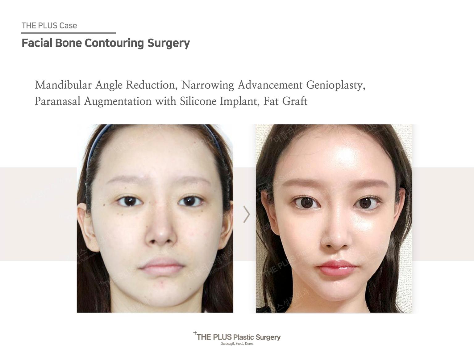 Mandibular Angle Reduction & Narrowing Advancement Genioplasty & Paranasal Augmentation With Silicone Implant & Fat Graft