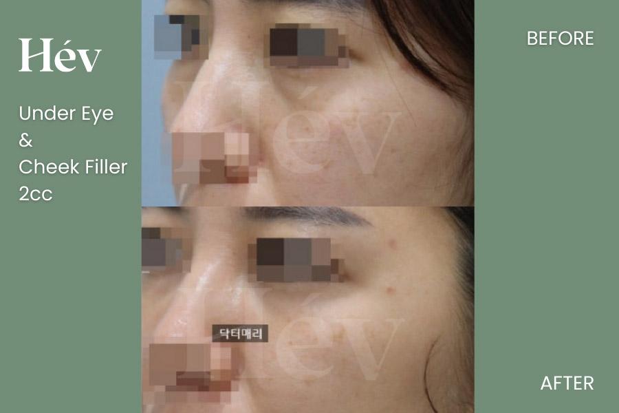 Under Eye Cheek Filler 2cc
