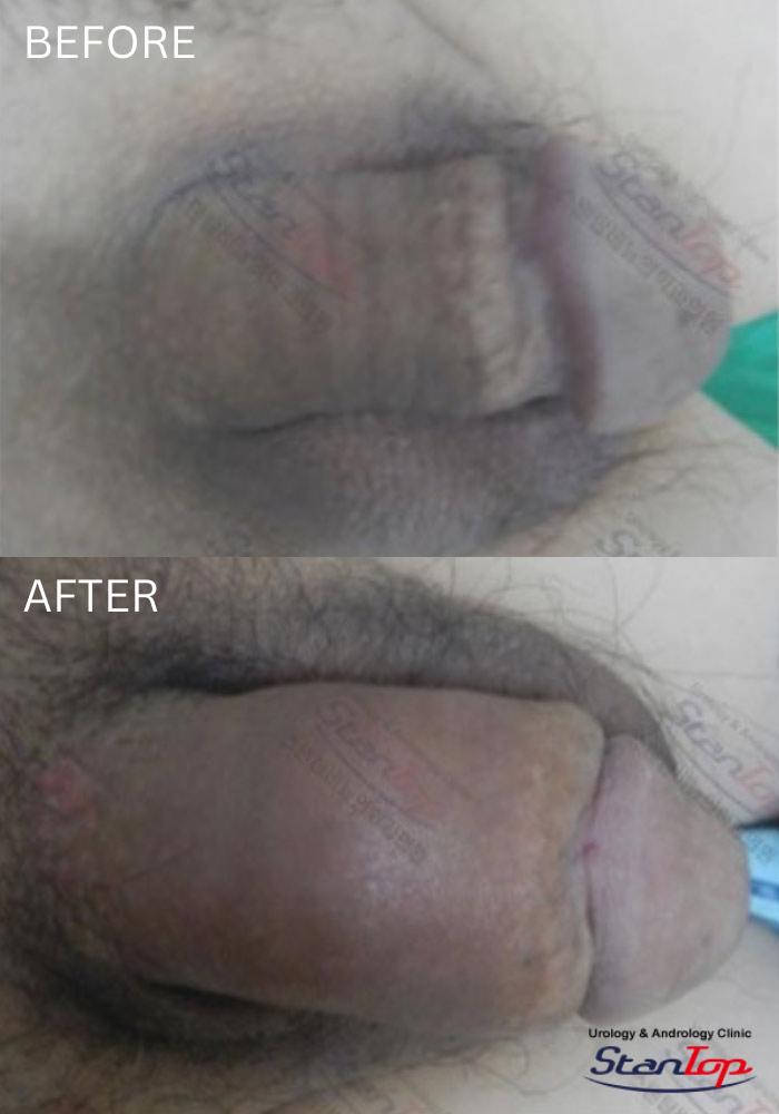 Stantop Penis Adm Filler