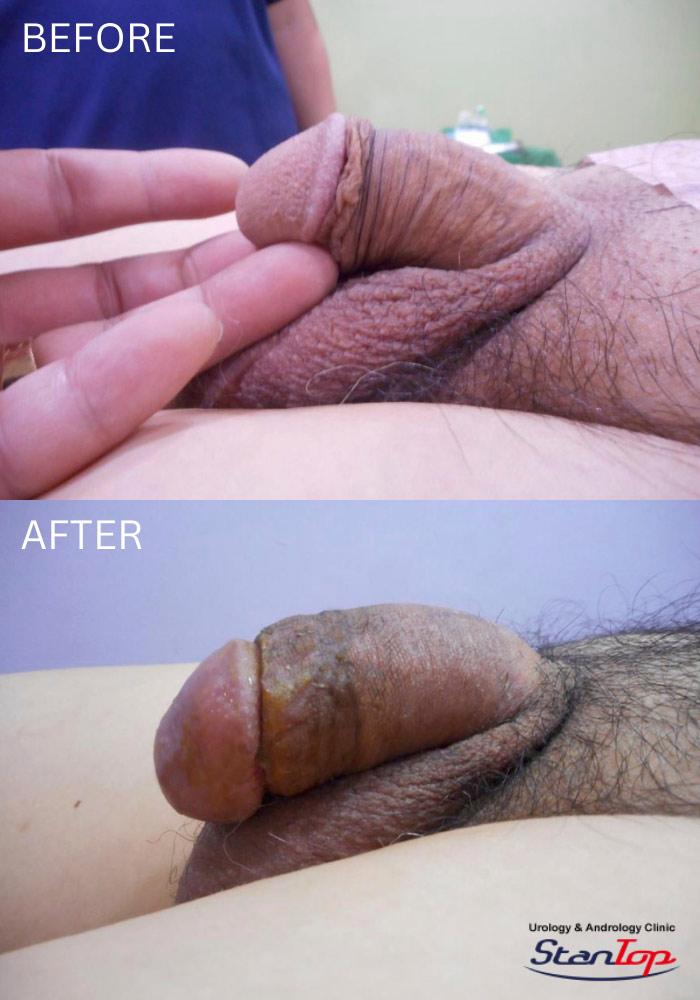 Before and After Penis Enlargement