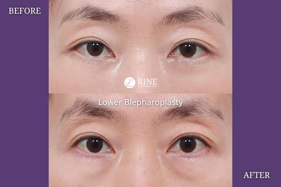 Lower Blepharoplasty