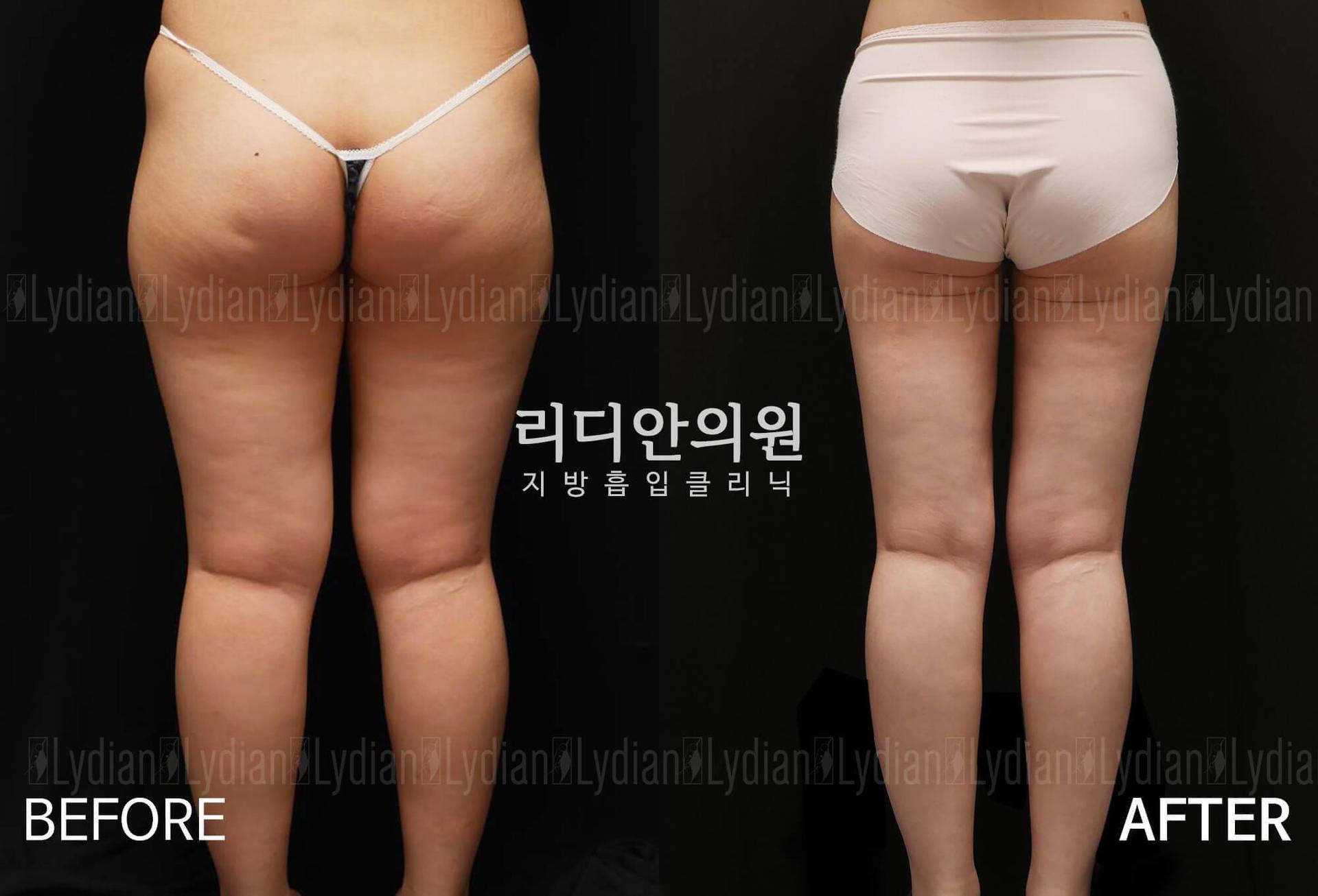 lydian-female-thai-liposuction-02.jpg