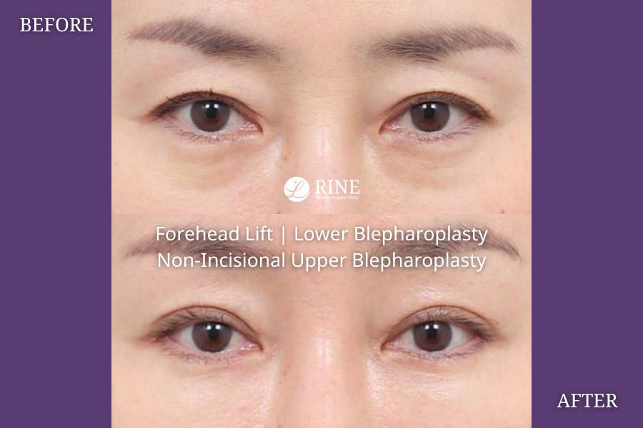 Forehead Lift non incisional upper blepharoplasty lower blepharoplasty