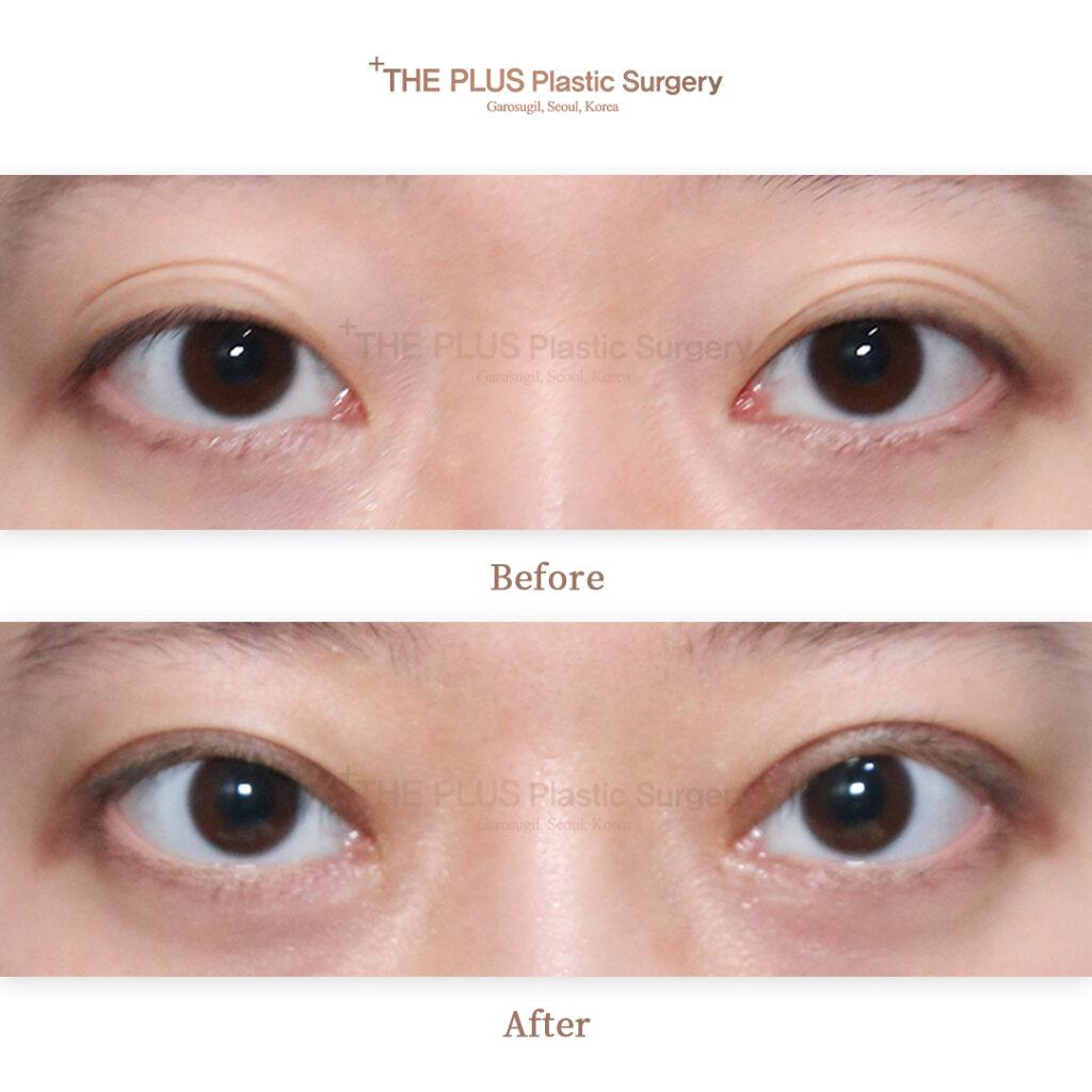 Non Incisional Double Eyelid
