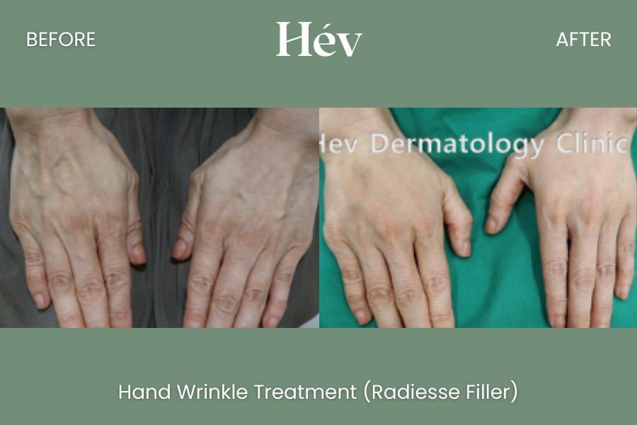 Hand Wrinkle Treatment Radiess Iller