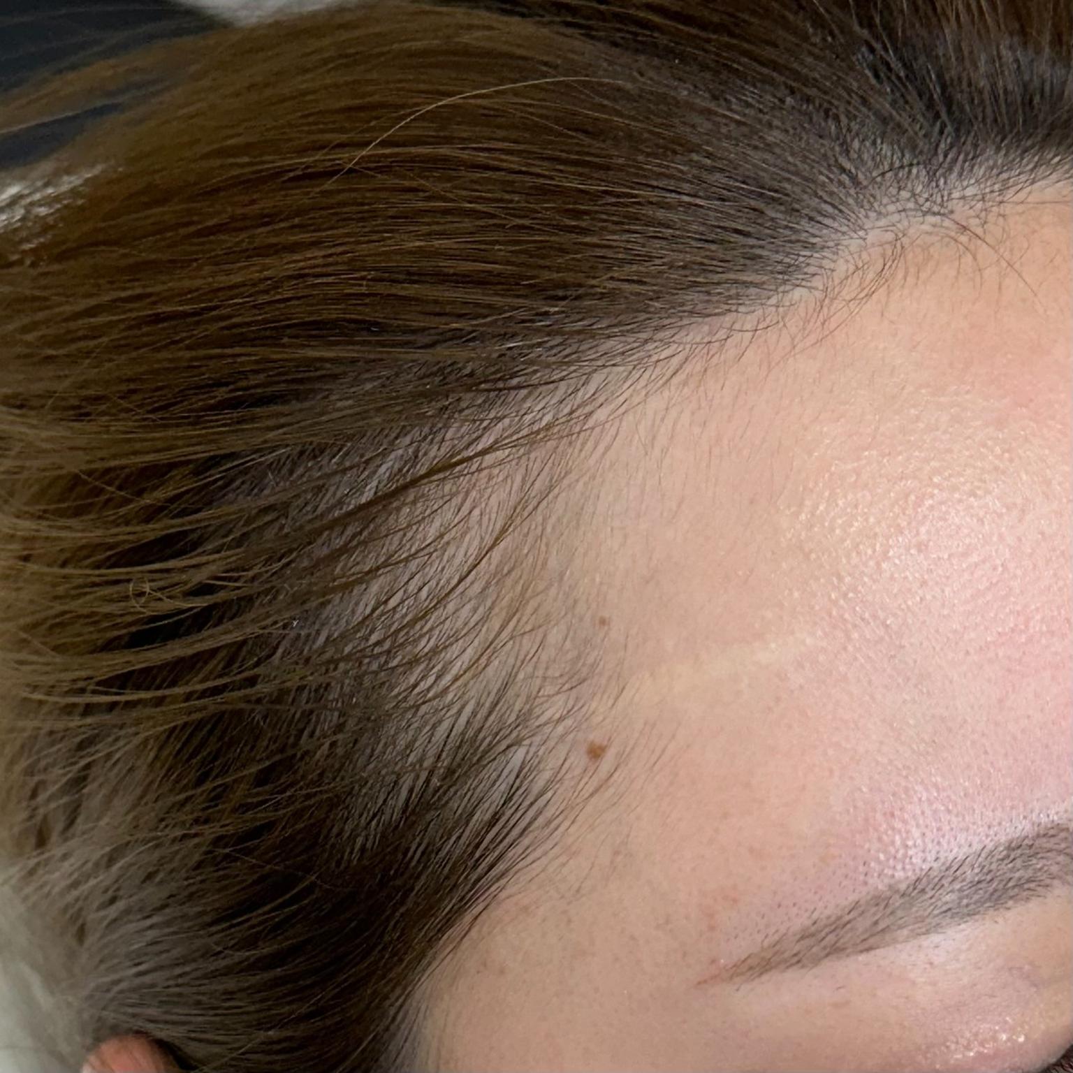 Hairline Microblading (M-shape, βM-boβ technique)
