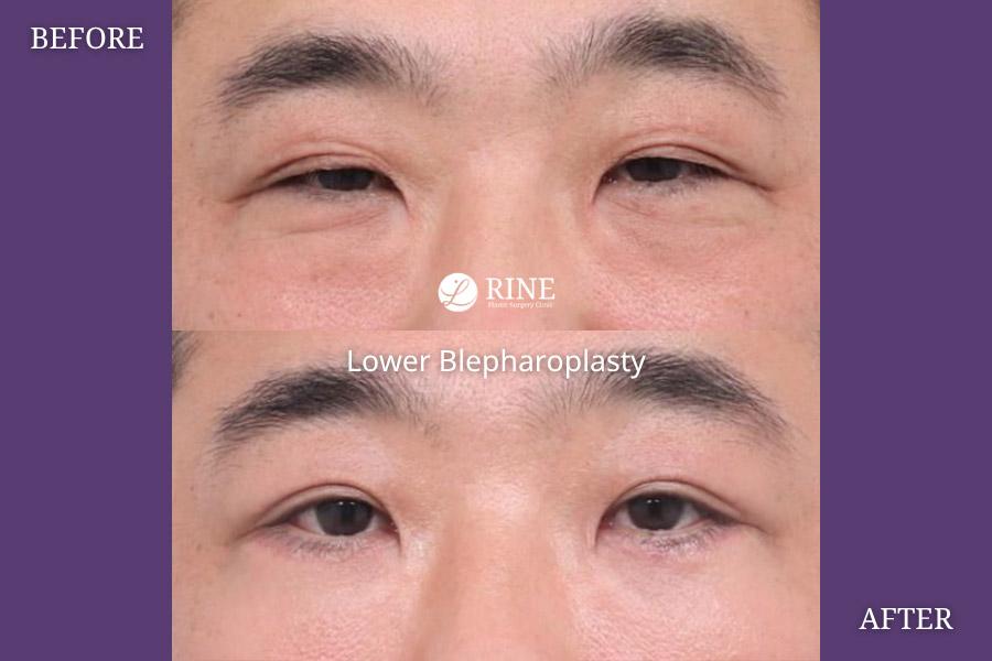 Lower Blepharoplasty