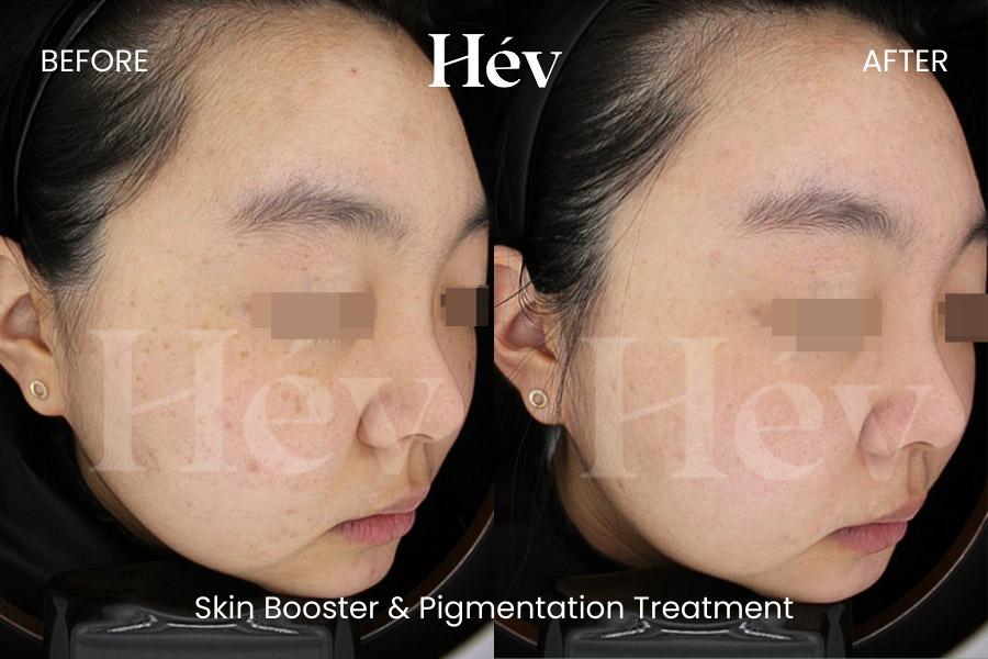 Skin Booster Pigmentation Treatment