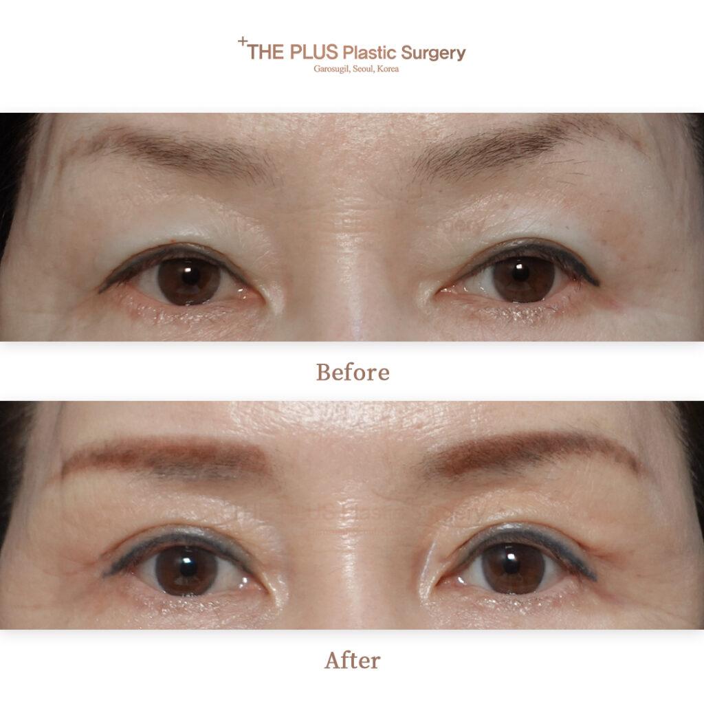Upper Blepharoplasty