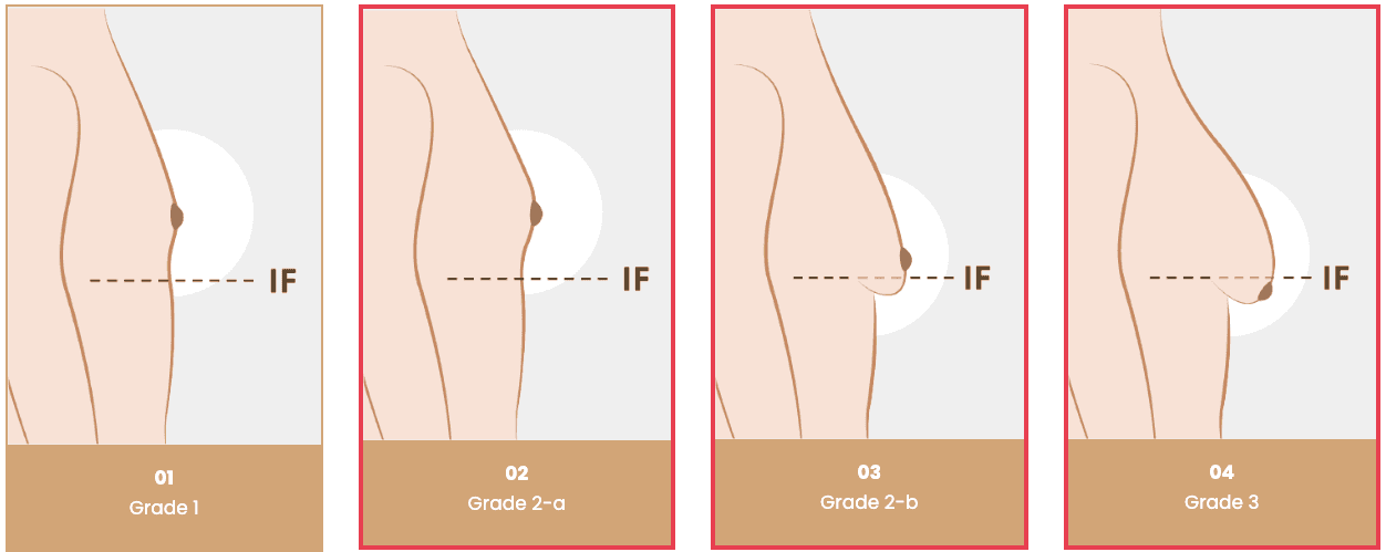 Gynecomastia