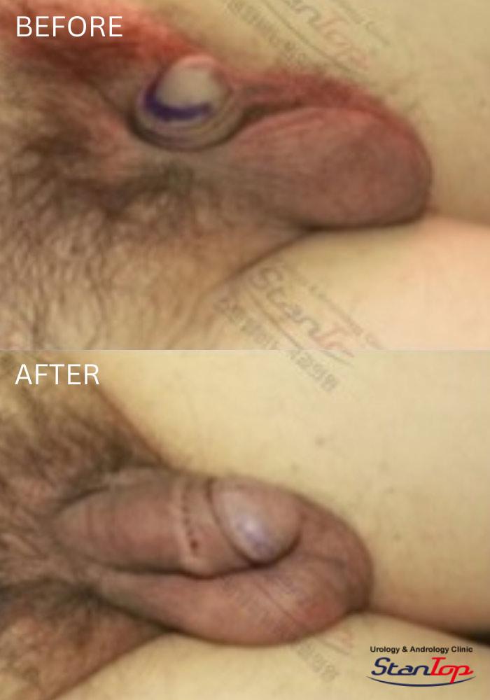 Stantop Penis Lengthening