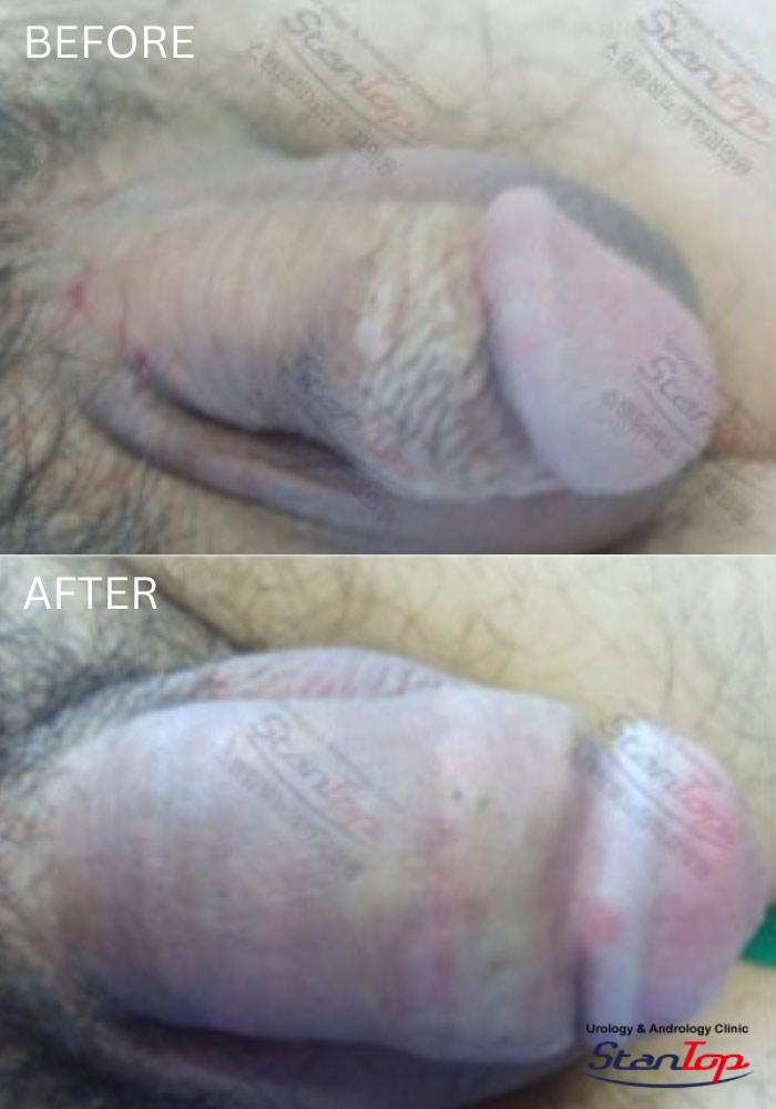 Stantop Penis Filler