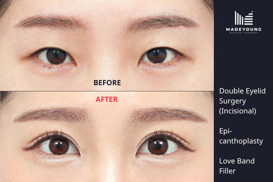 Eyelid surgery incisional epicanthoplasty aegyo filler