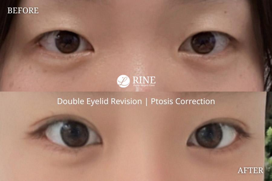 Double Eyelid revision ptosis correction