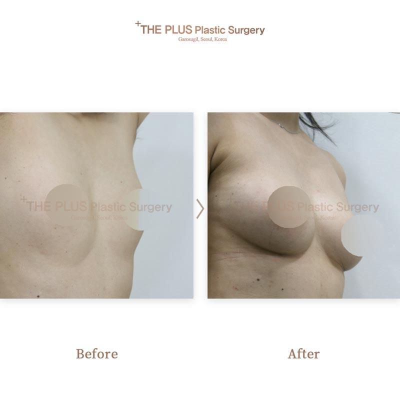 Breast augmentation with autologous fat grafting