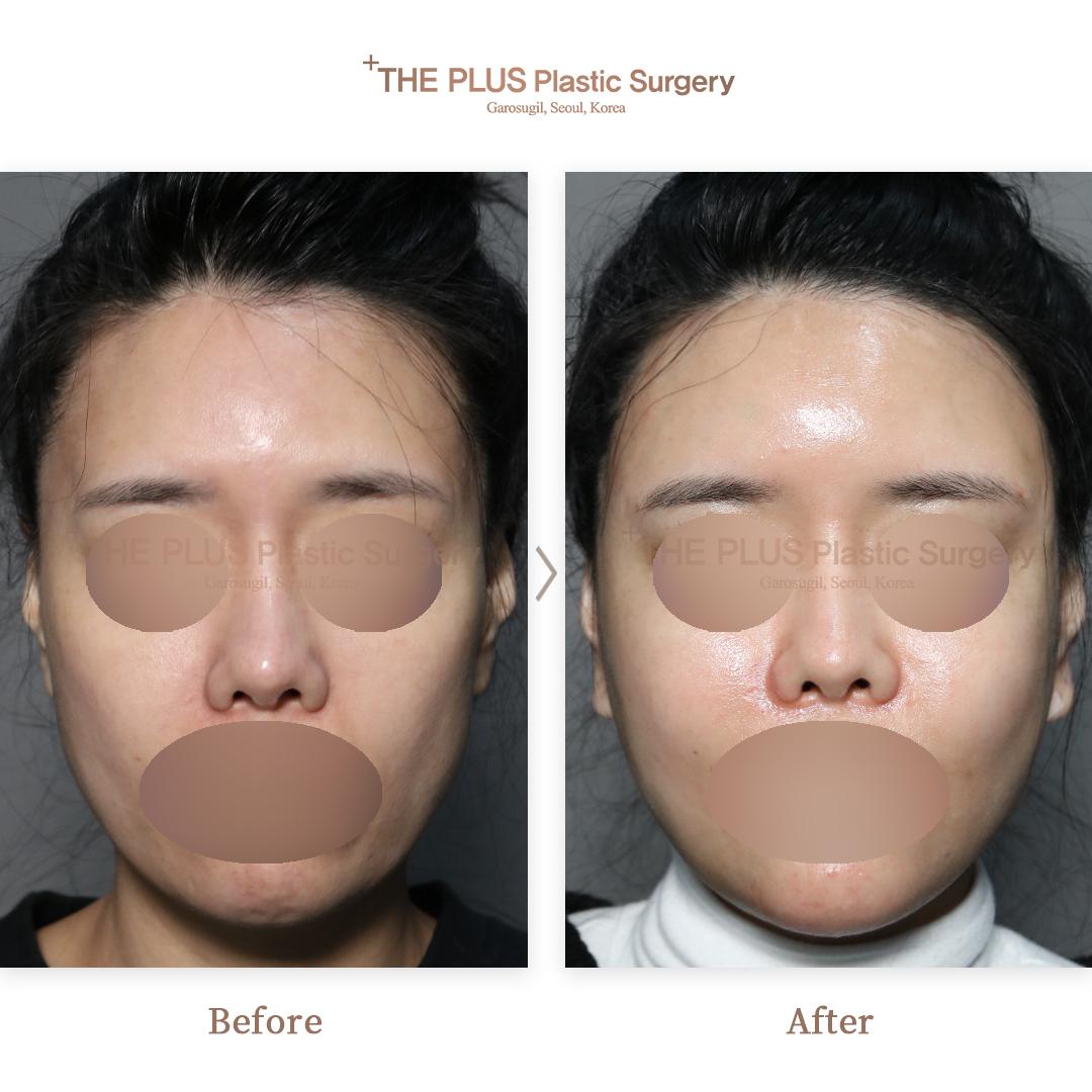 Face contouring + Mini Face Lifting + Thread Lifting + Double Chin Tightening