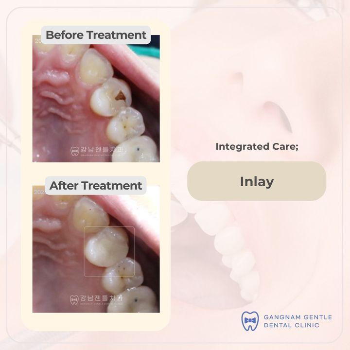 Maßgefertigte Dental-Inlays helfen, ein natürliches Lächeln wiederherzustellen. Sie sind stabil, fügen sich nahtlos ein und bieten eine ästhetisch ansprechende Restauration. Ein Inlay ist eine individuell angefertigte zahnärztliche Versorgung aus Materialien wie Porzellan, Keramik oder Kompositharz. Es wird verwendet, wenn die Schädigung oder Karies für eine einfache Füllung zu ausgeprägt ist, jedoch noch keine Krone erforderlich macht.