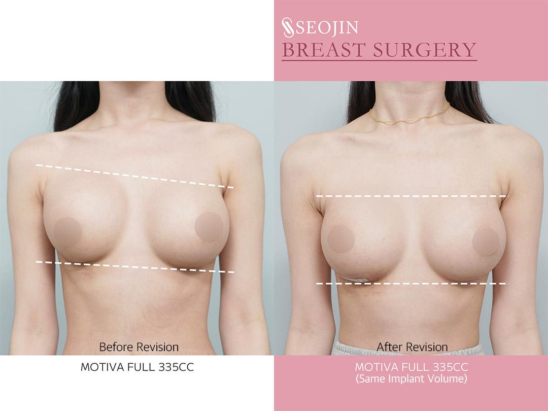 Seojin Plastic Surgery Clinic before and after image
