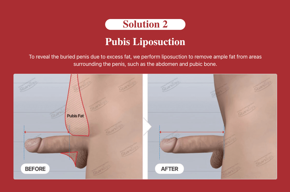 Pubic Fat Pad Removal