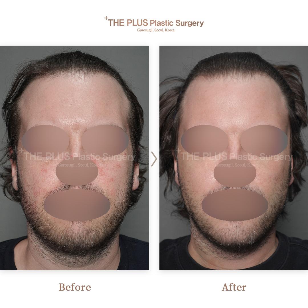 THEPLUS Plastic Surgery before and after image