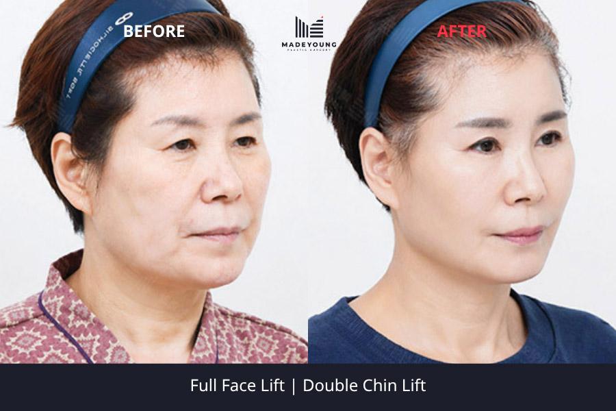 Face lift double chin lift