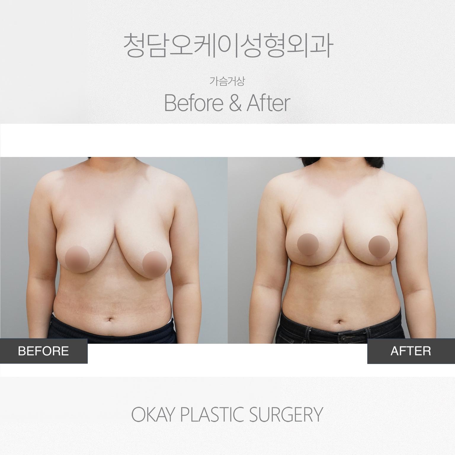 Okay Plastic Surgery Clinic before and after image