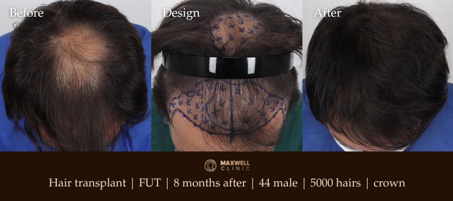 Before and After Hair Transplant
