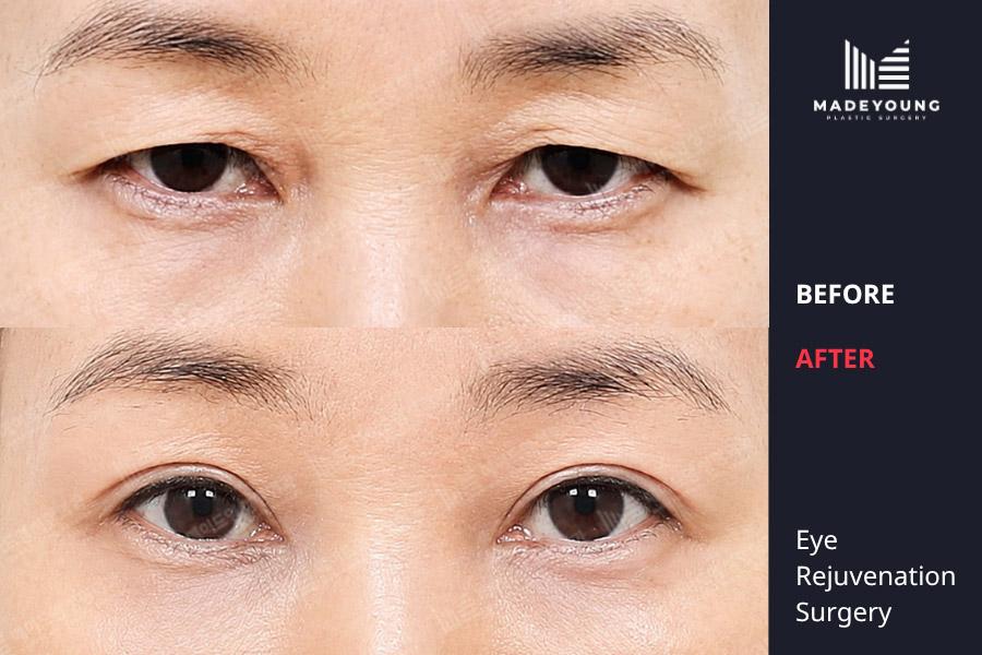 Made Young Plastic Surgery before and after image