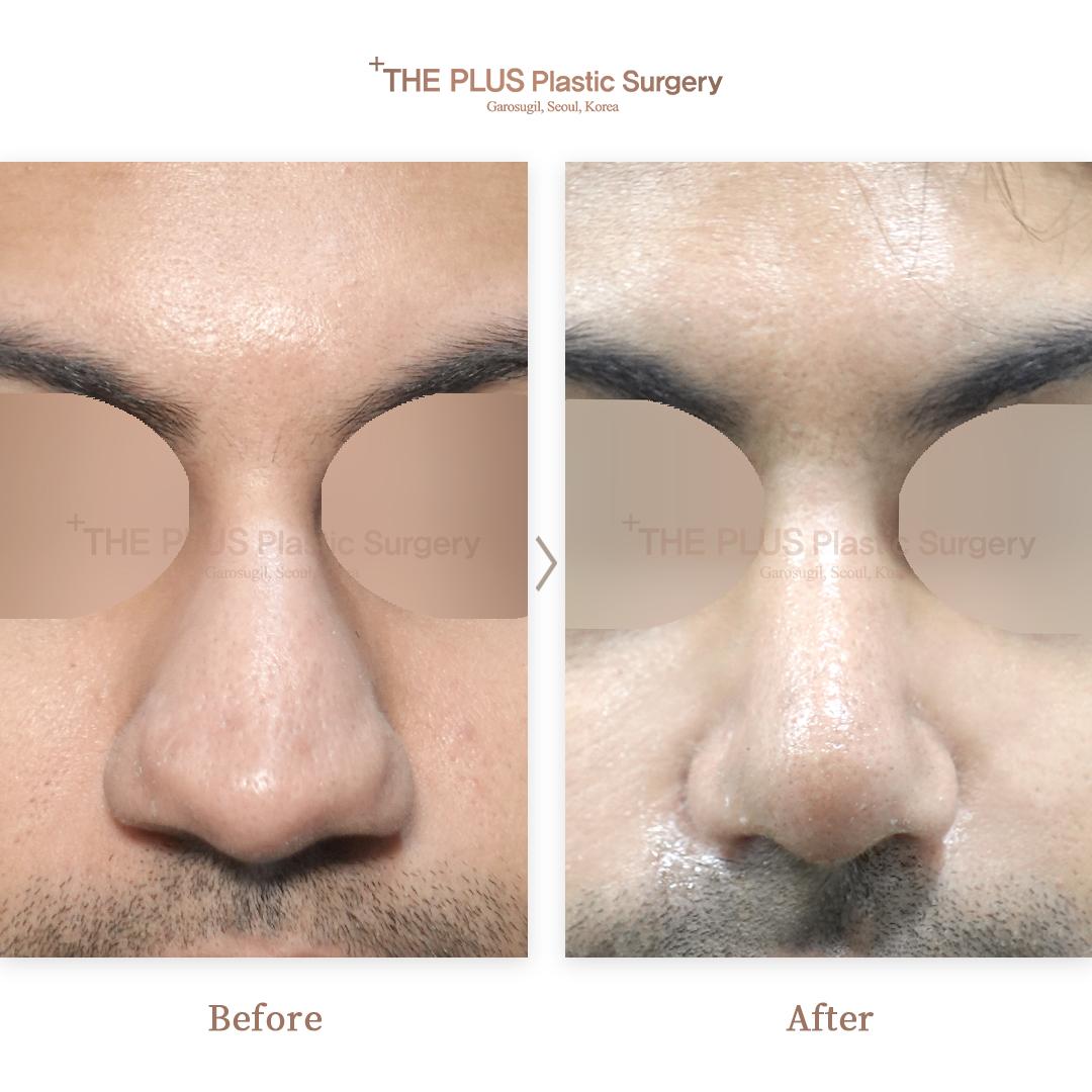 Primary Rhinoplasty & Hump Correction & No Silicone & Ear Cartilage & Septal Cartilage & Alar Reduction