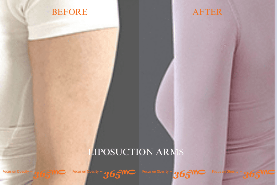 Liposuction - arms