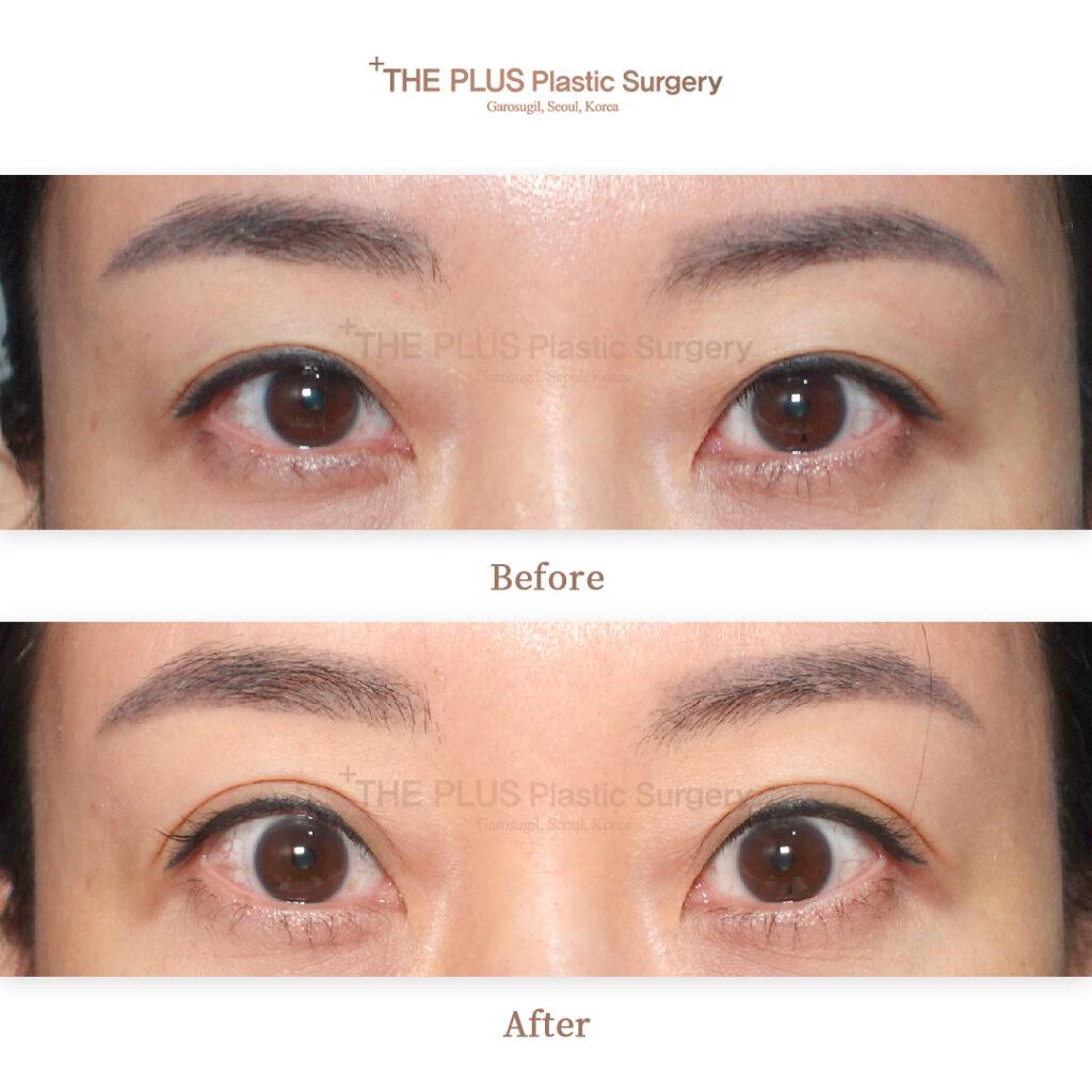 Revision Non Incisional Double Eyelid