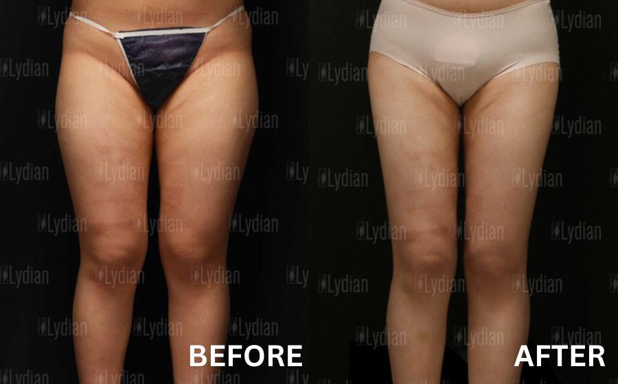 Lydian Plastic Surgery Clinic before and after image