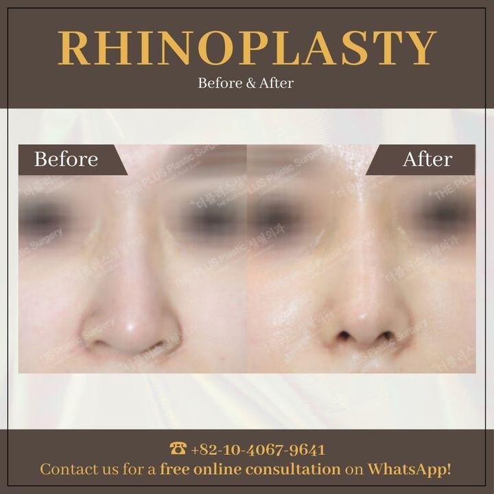 Enhance your natural beauty with our rhinoplasty procedures. Our before and after photos highlight the precision and care we bring to every transformation.