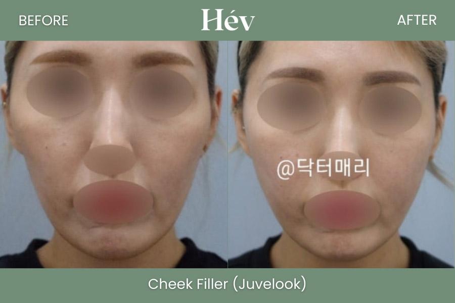 Cheek Fille Juvelookr