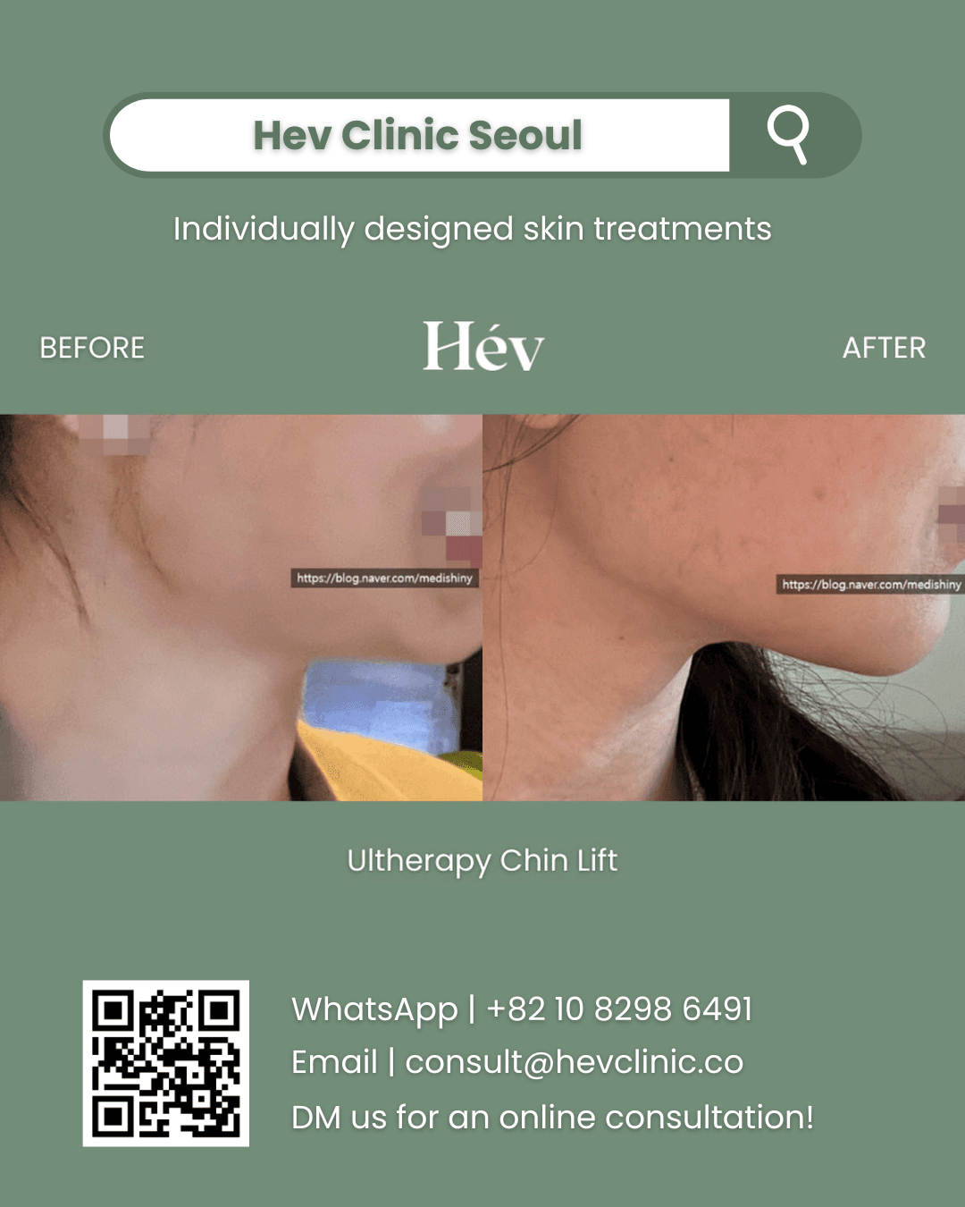 Ultherapy Lifting, Double Chin Tightening