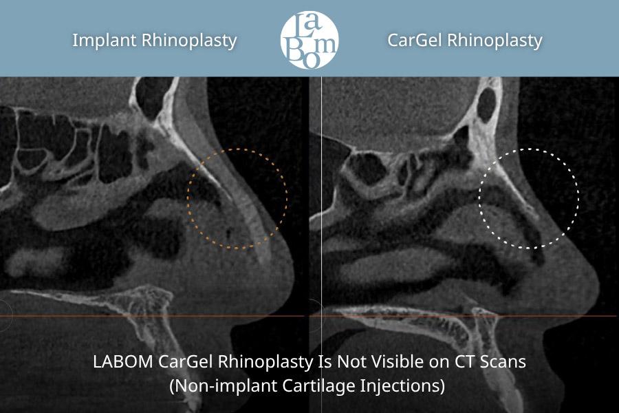 Non-Surgical Rhinoplasty, Non-Implant Rhinoplasty