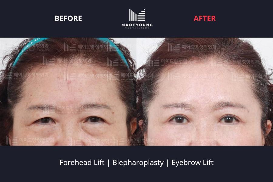 Made Young Plastic Surgery before and after image