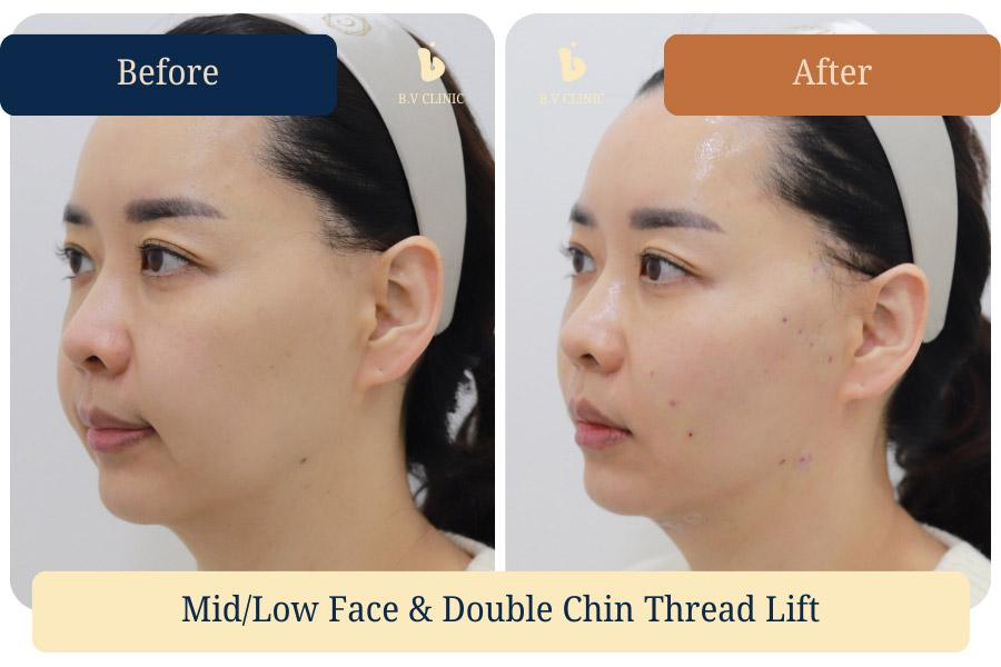 Midface (nasolabial area), lower face, and double chin thread lifting. The patient requested maximum lifting of the heavier nasolabial (anterior cheek) area. Before and after photos taken on the day of the procedure.
