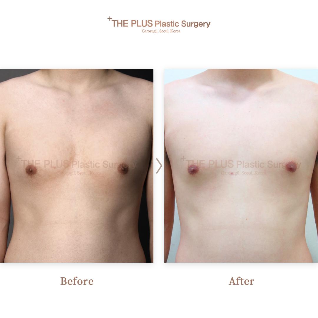THEPLUS Plastic Surgery before and after image