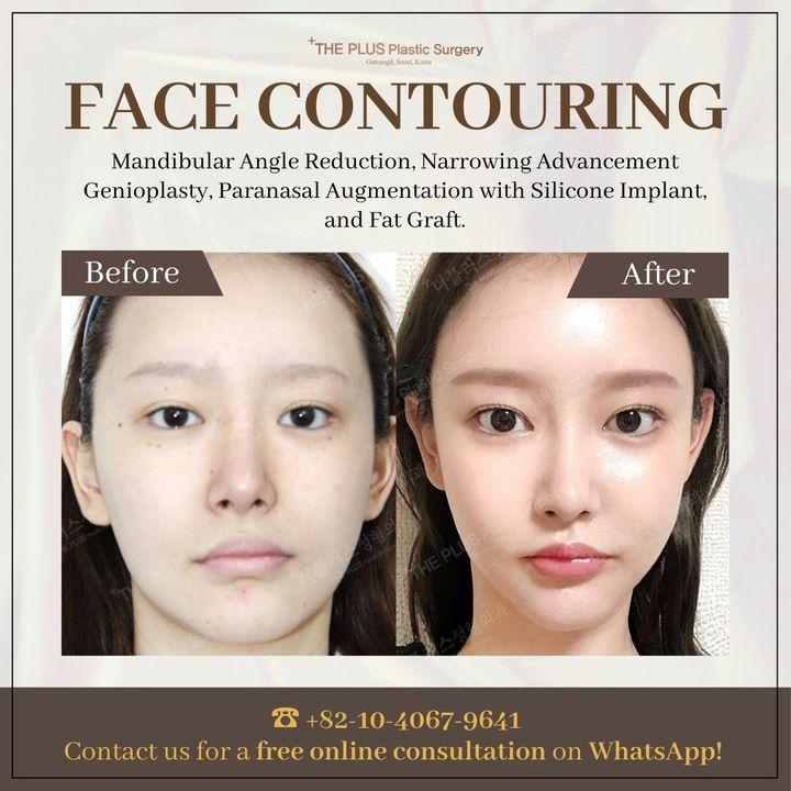 Our surgical expertise in mandibular angle reduction, genioplasty, and paranasal augmentation creates a harmonious, sculpted facial profile.