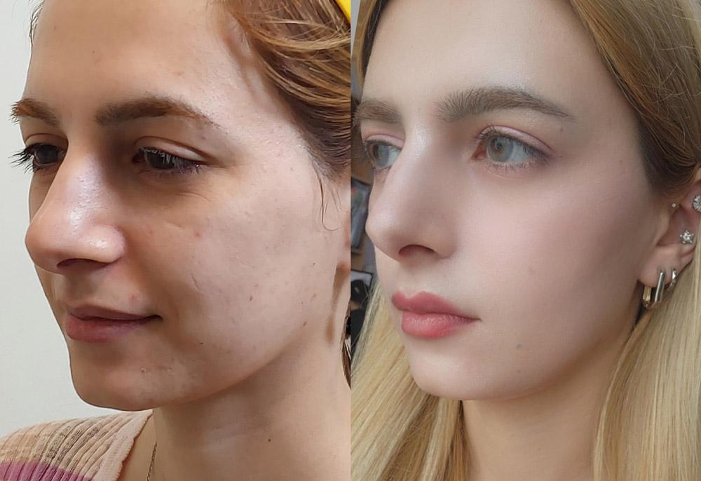 Female forehead eyebrow thread lift 2 weeks