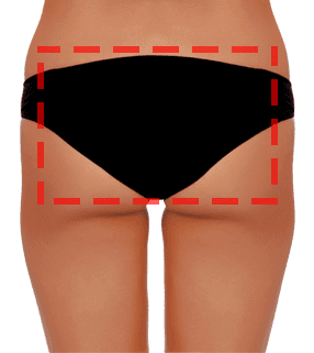 Brazilian Butt Lift
